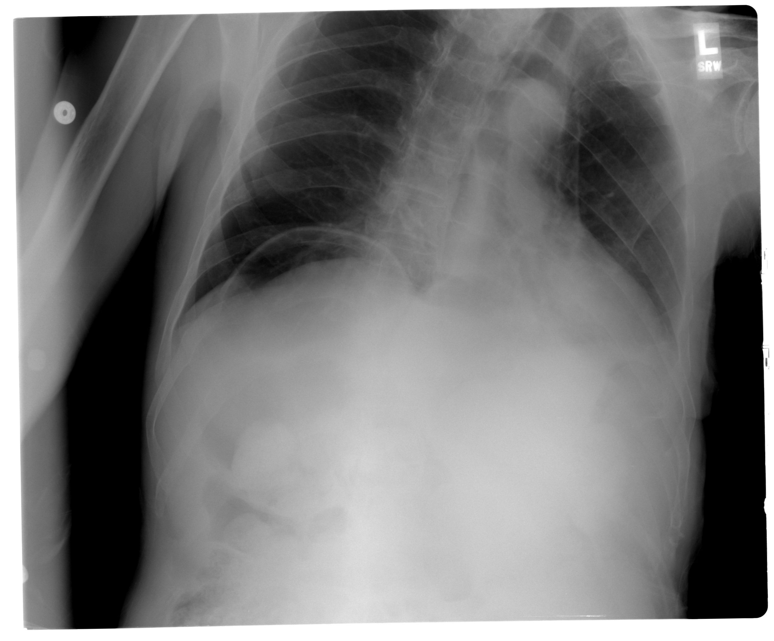 Pneumoperitoneum