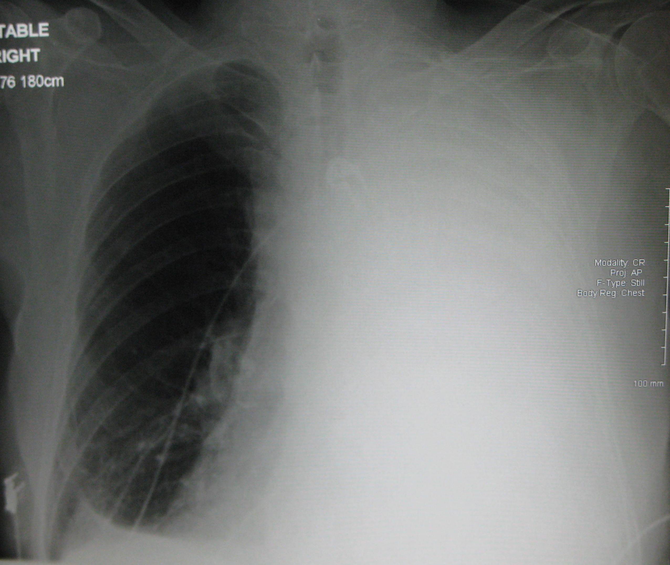 Massive Pleural Effusion