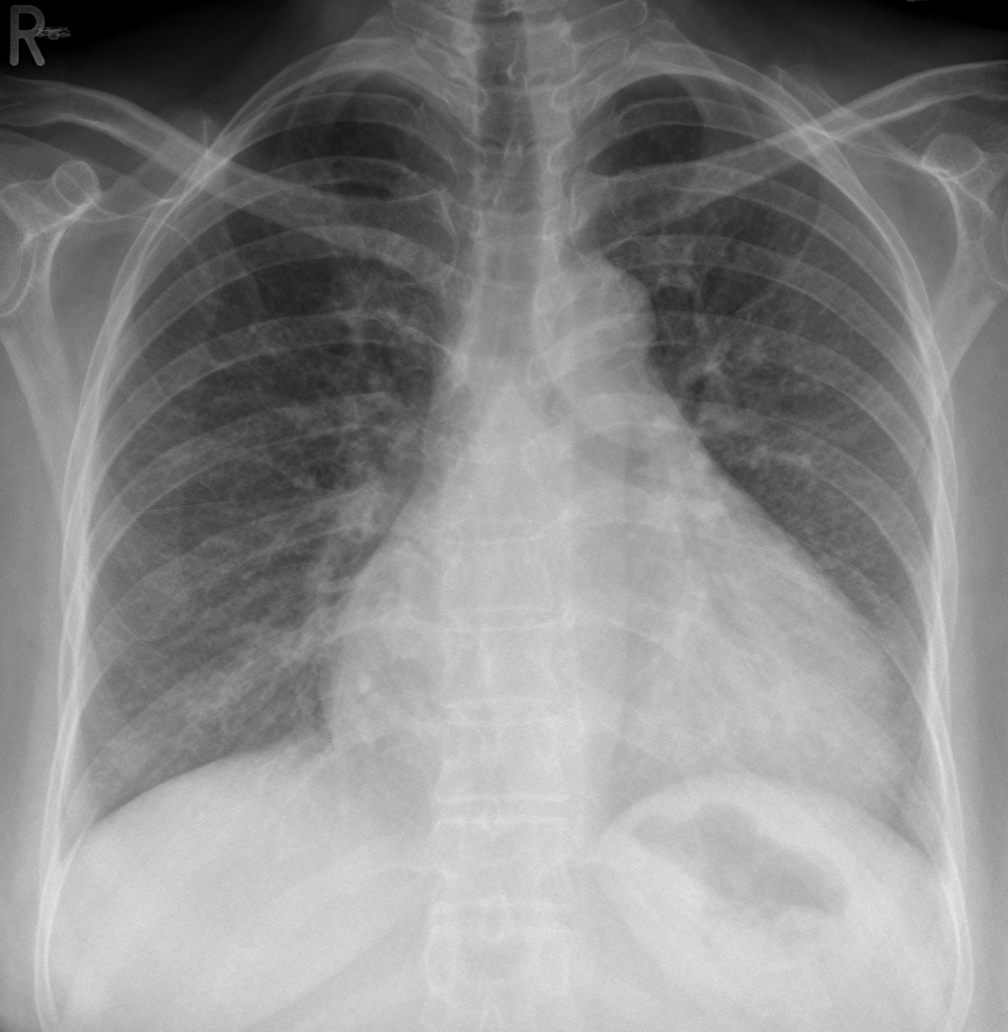 Pericardial Effusion